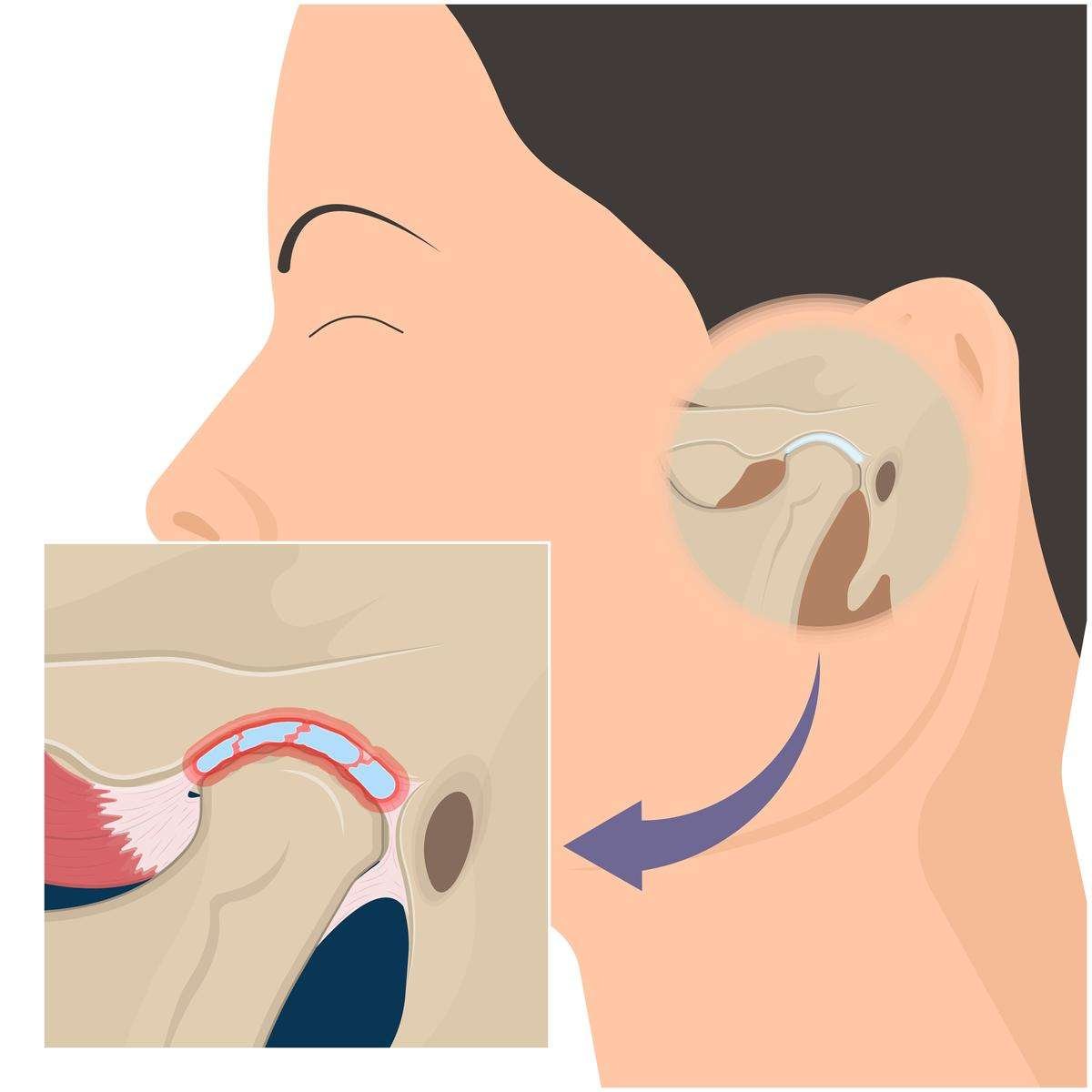 oral appliance for sleep apnea