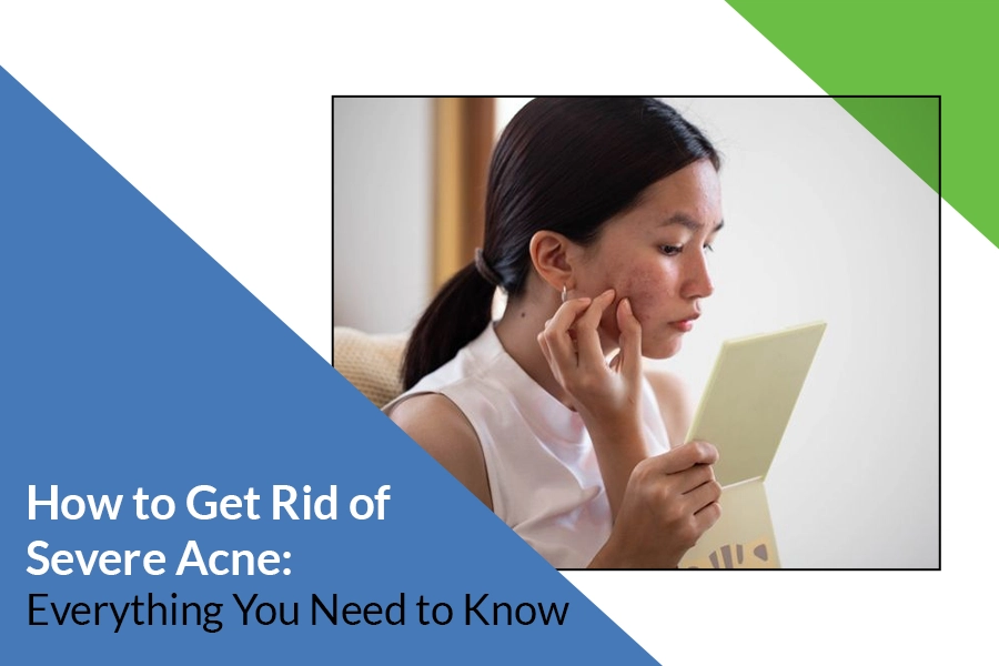How to Get Rid of Severe Acne: Everything You Need to Know